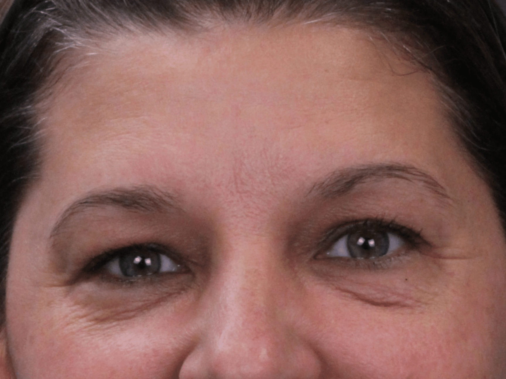 Before Image: Upper & Lower Eyelid Lift, Fat Grafting & Under Eye Laser - front