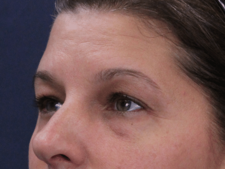 Before Image: Upper and Lower Eyelid Lift, Under Eye Laser Resurfacing - left-front-oblique