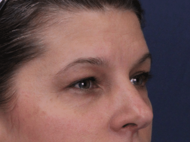 Before Image: Upper and Lower Eyelid Lift, Under Eye Laser Resurfacing - right-front-oblique