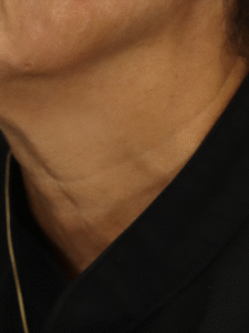 After Image: Chemical Peel & Removal of Neck Moles