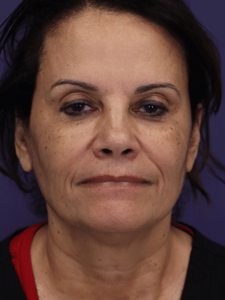 Before Image: TCA Peel - front