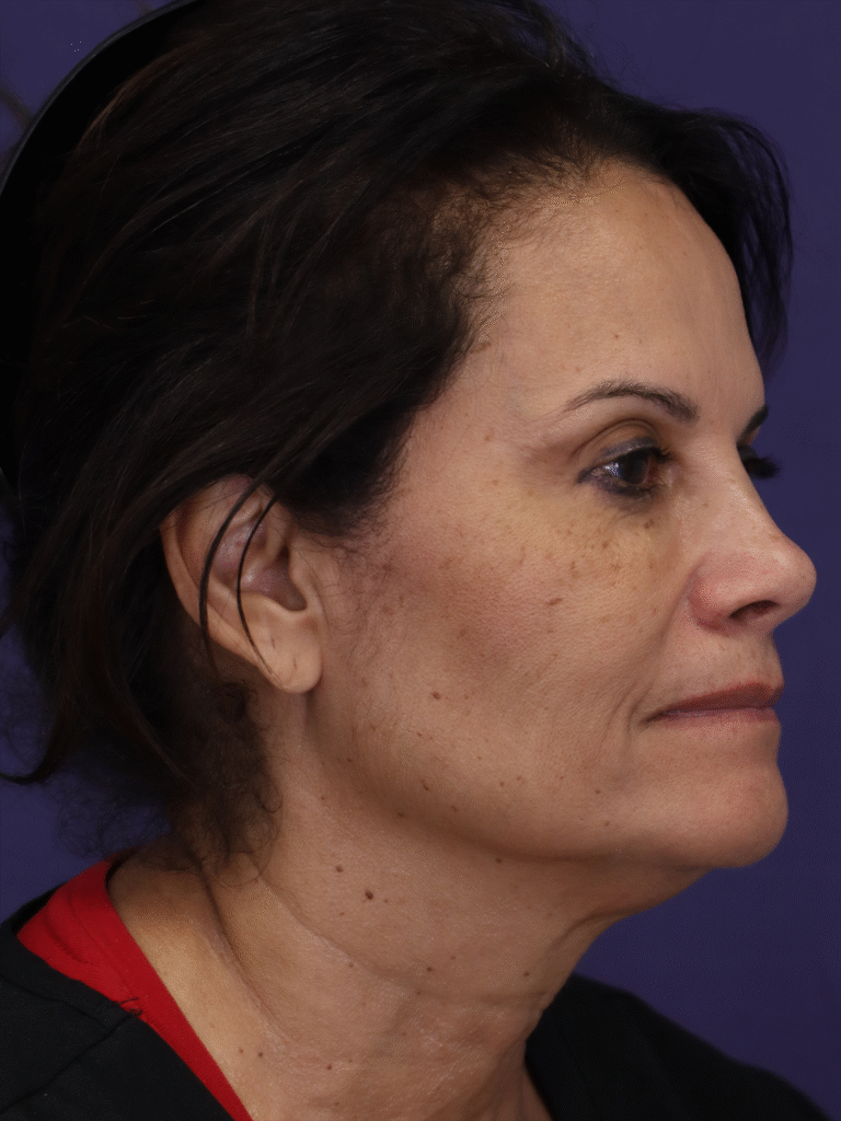 Before Image: TCA Peel - right-front-oblique