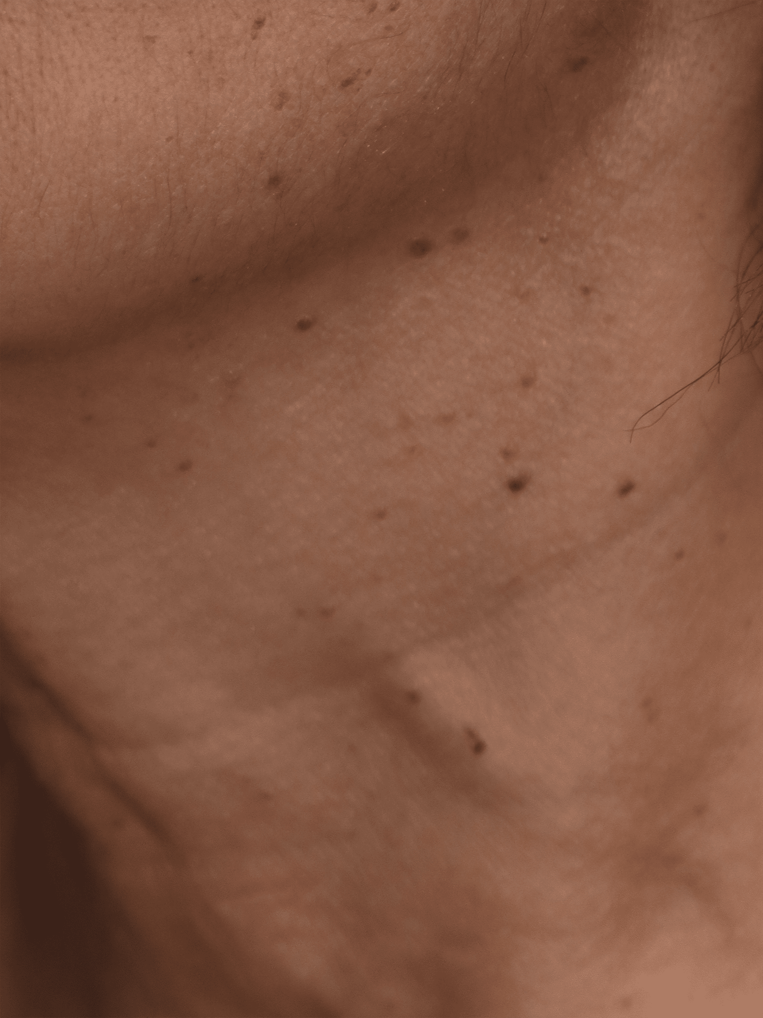 Before Image: Removal of Neck Moles - left-front-oblique