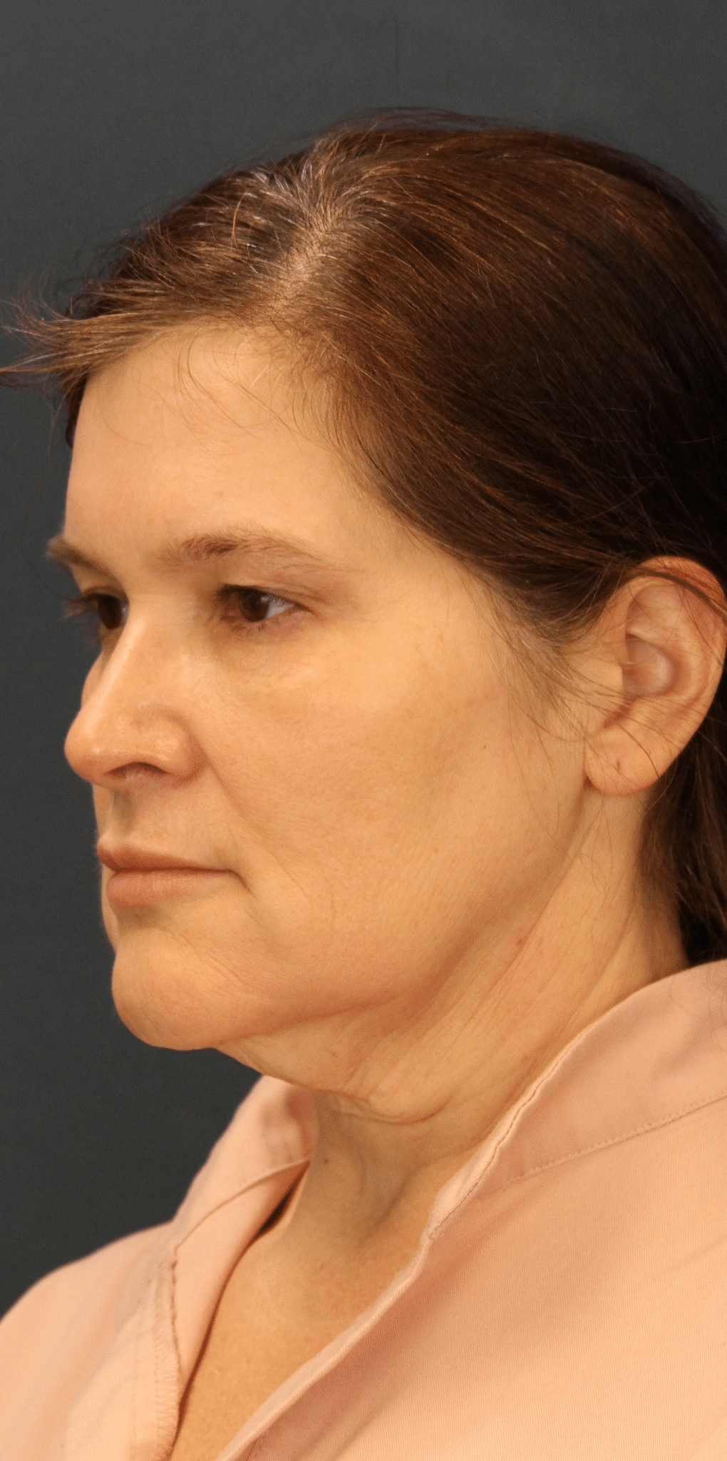 Before Image: MyEllevate Minimally Invasive Neck Lift
