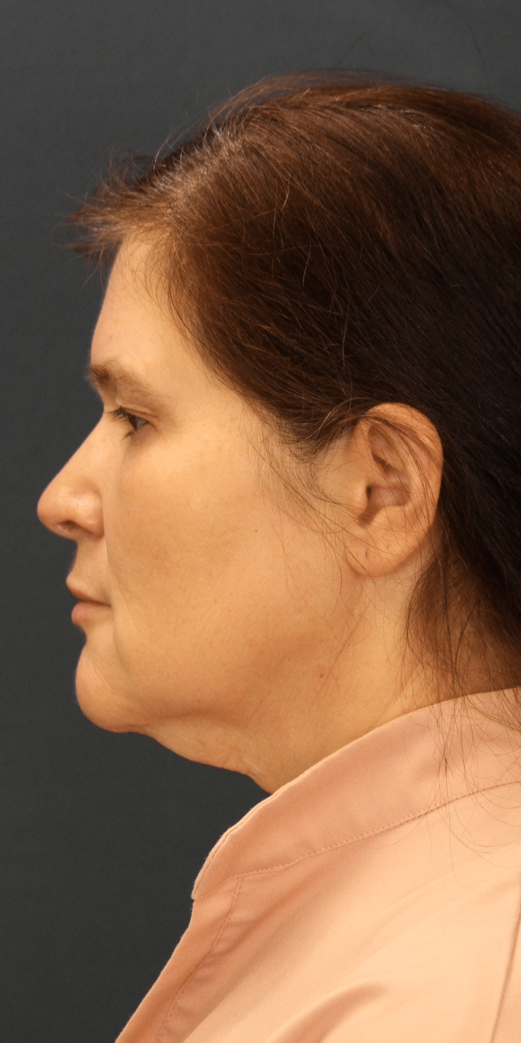 Before Image: MyEllevate Minimally Invasive Neck Lift - 