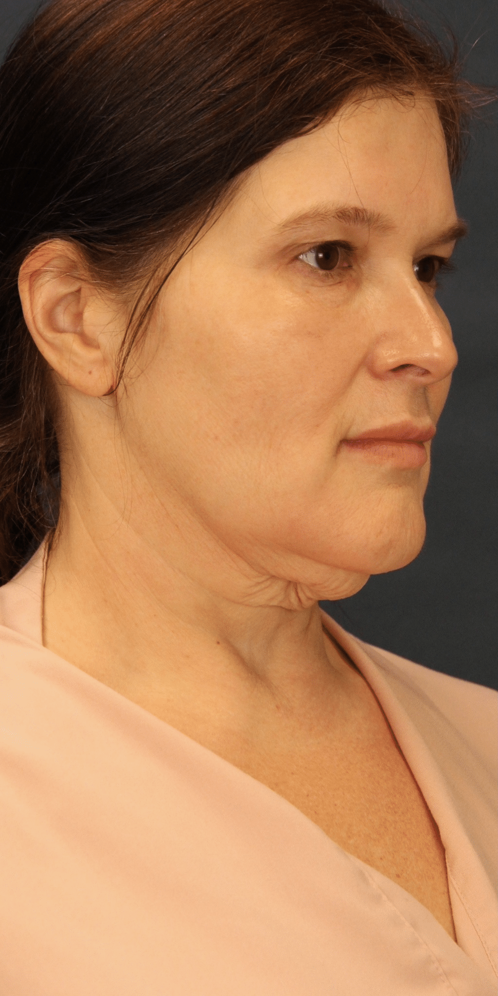 Before Image: MyEllevate Minimally Invasive Neck Lift - 