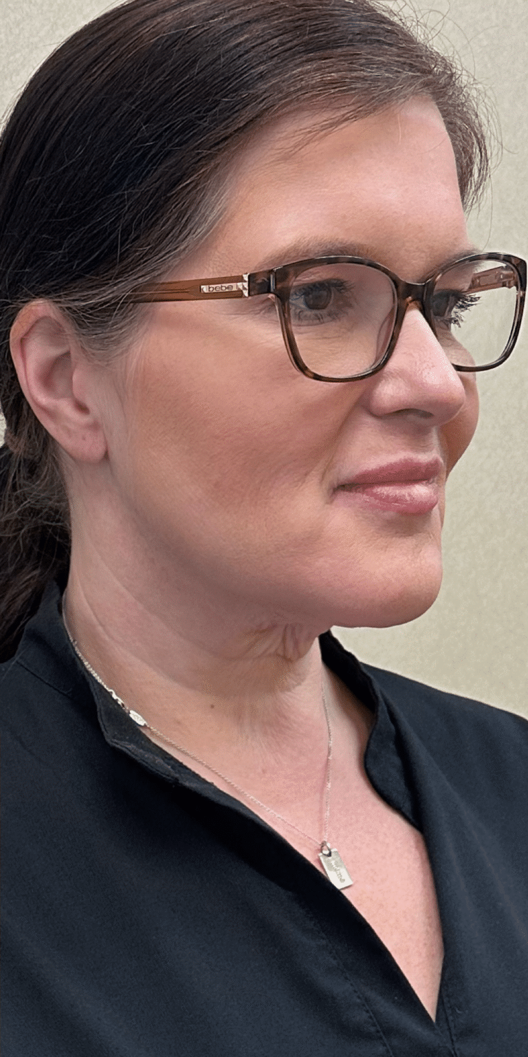 After Image: MyEllevate Minimally Invasive Neck Lift - 
