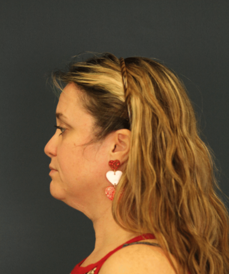 Before Image: SMAS Facelift and Extended Deep Plane Neck Lift - left-side