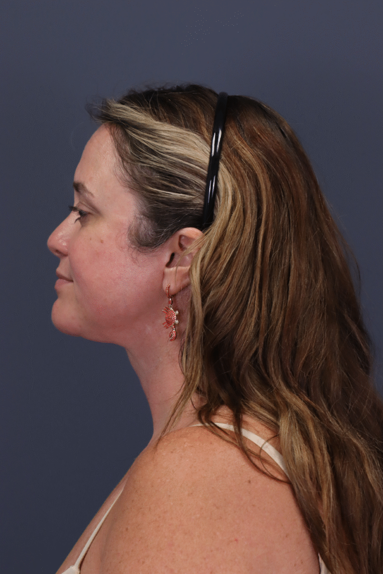 After Image: SMAS Facelift and Extended Deep Plane Neck Lift - left-side
