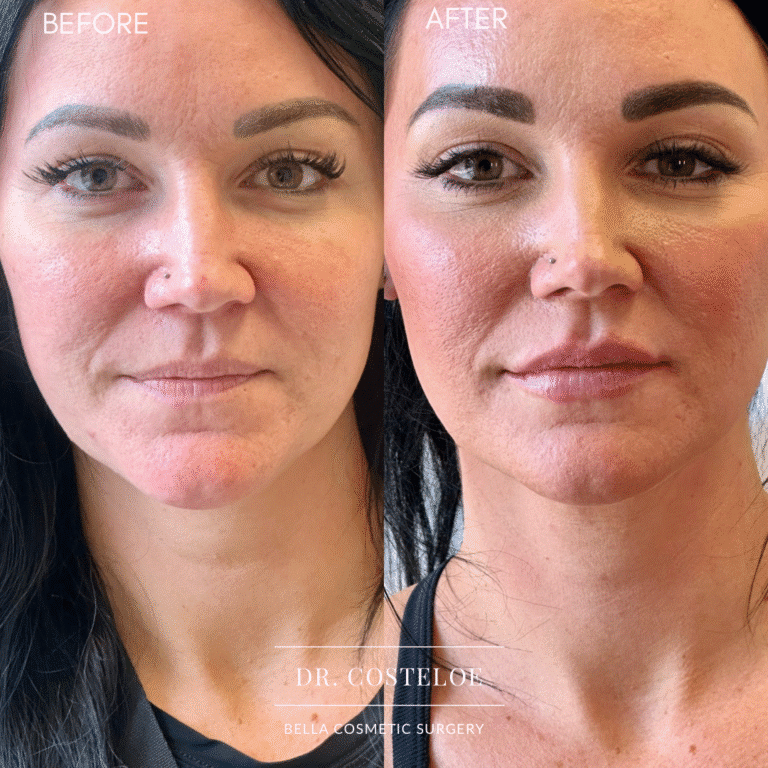 After Image: Filler by Dr. Costeloe - front