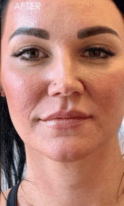 After Image: Filler by Dr. Costeloe