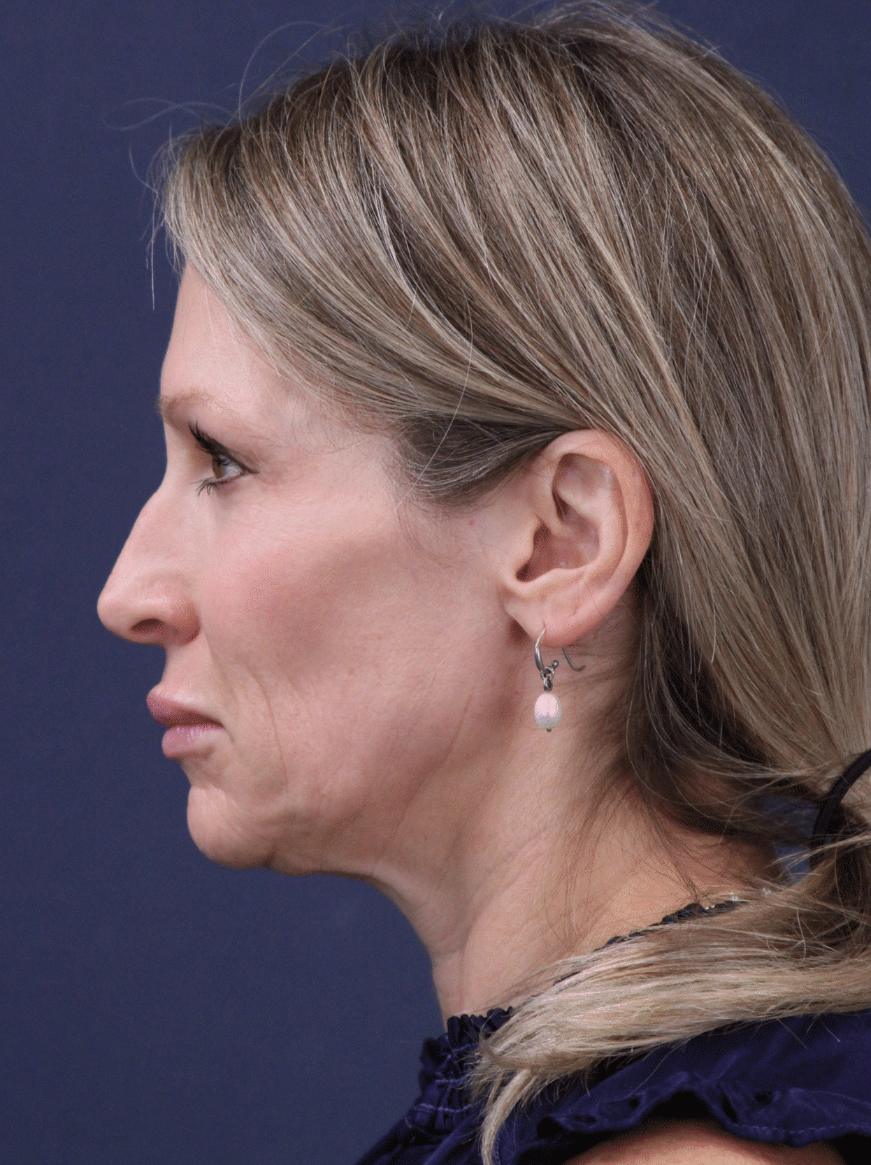 Before Image: MyEllevate Minimally Invasive Neck Lift - left-side