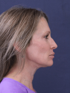 After Image: MyEllevate Minimally Invasive Neck Lift