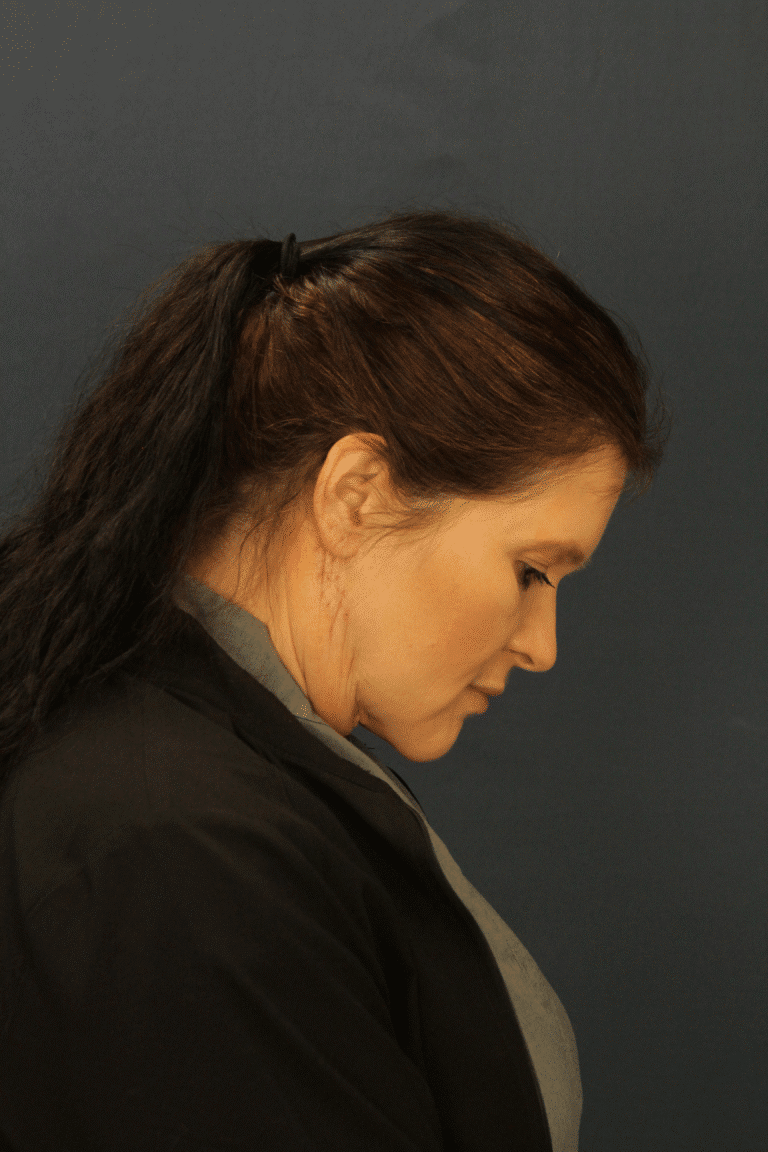 After Image: MyEllevate Minimally Invasive Neck Lift -