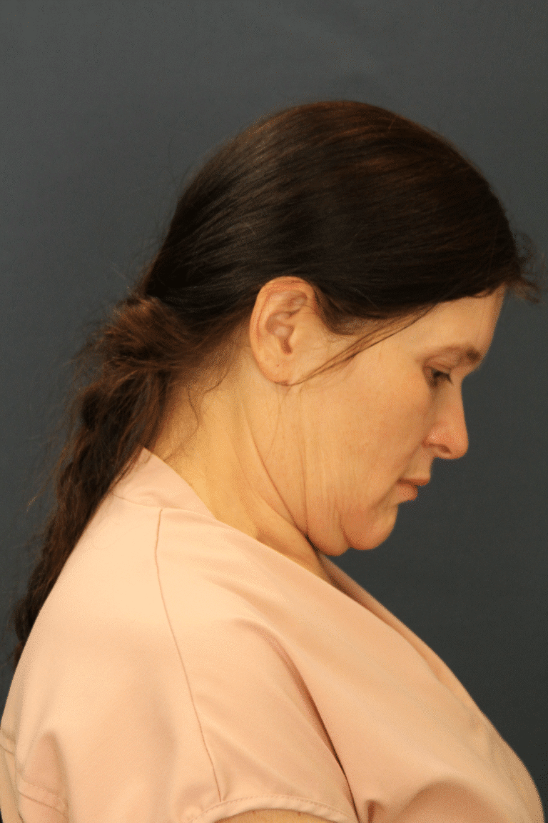 Before Image: MyEllevate Minimally Invasive Neck Lift -
