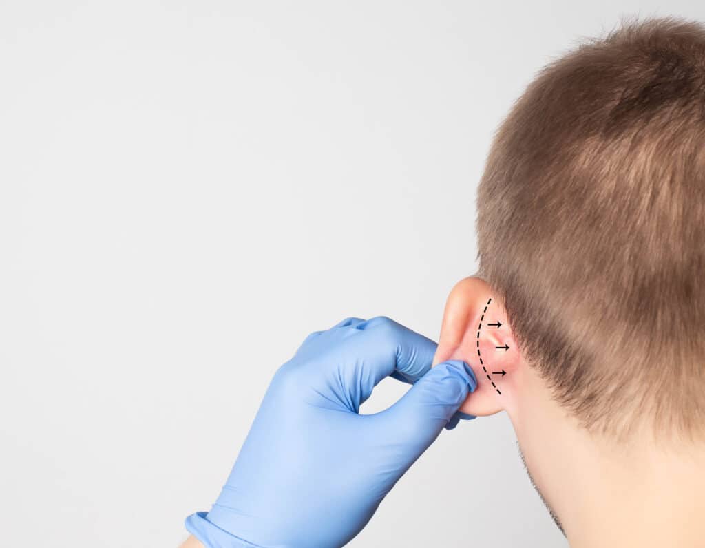 A doctor examines and marks up a patient's ear to prepare for otoplasty ear pinning surgery