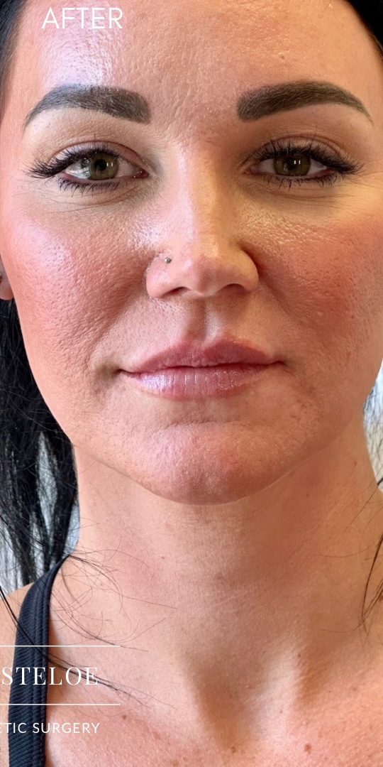 After Image: 35YO, Female, RHA2 Lip Fillers - front