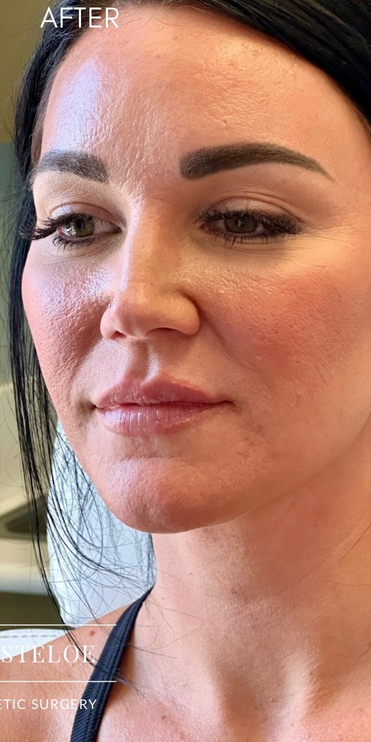 After Image: 35YO, Female, RHA2 Lip Fillers - left-front-oblique