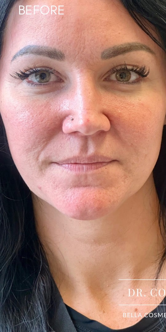 Before Image: 35YO, Female, RHA2 Lip Fillers - front