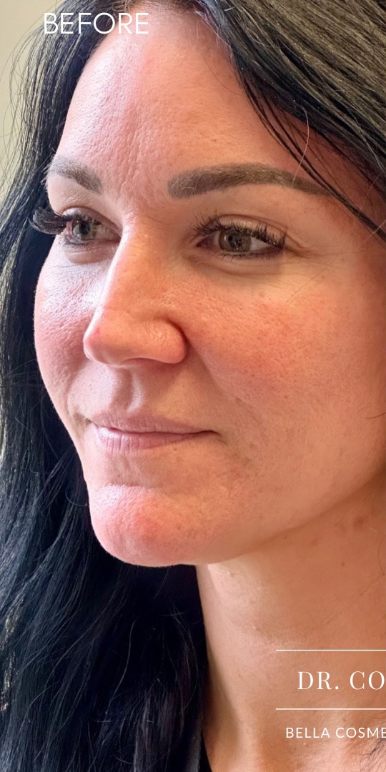 Before Image: 35YO, Female, RHA2 Lip Fillers - left-front-oblique