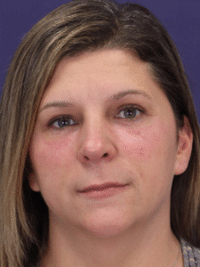 After Image: Transconjunctival Lower Blepharoplasty with Skin Pinch Excision, Upper Blepharoplasty, Facial Fat Grafting, Lower Lid Resurfacing