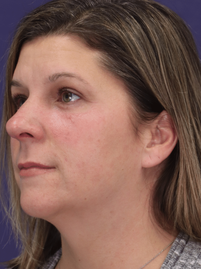 After Image: Transconjunctival Lower Blepharoplasty with Skin Pinch Excision, Upper Blepharoplasty, Facial Fat Grafting, Lower Lid Resurfacing - left-front-oblique