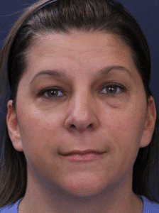 Before Image: Transconjunctival Lower Blepharoplasty with Skin Pinch Excision, Upper Blepharoplasty, Facial Fat Grafting, Lower Lid Resurfacing