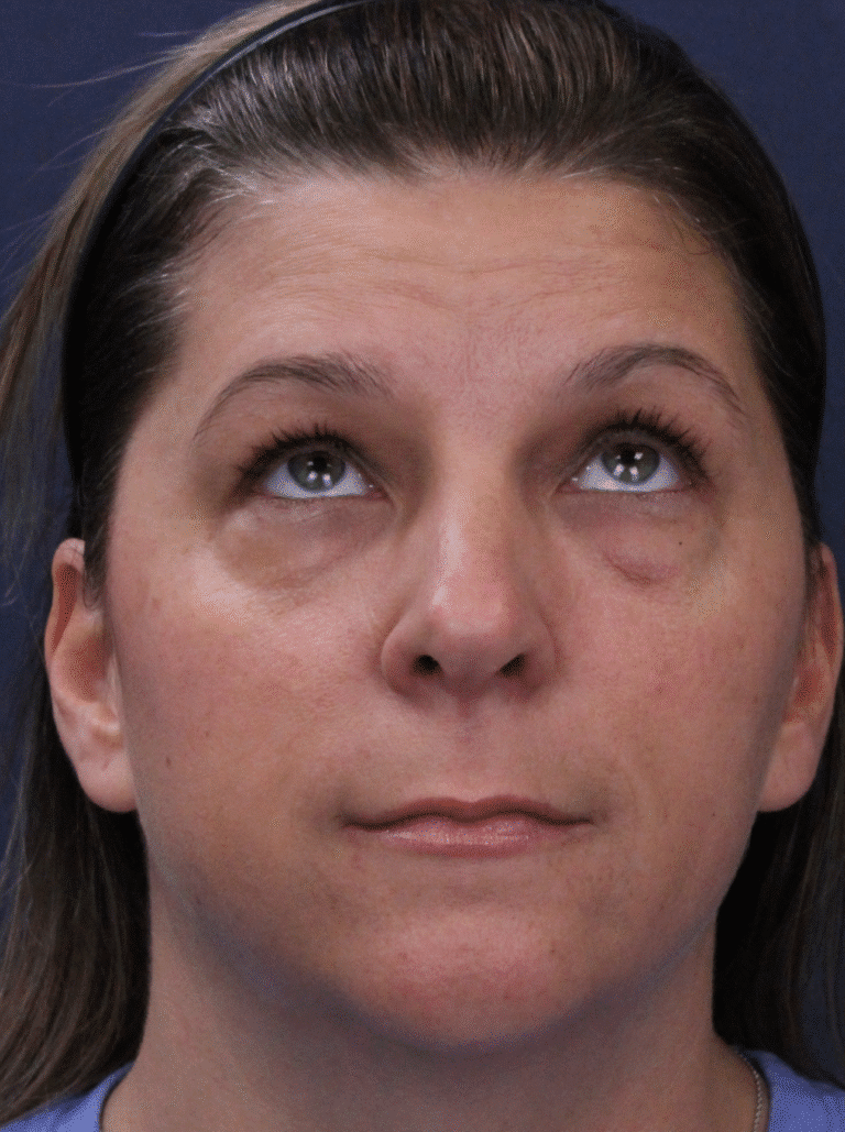 Before Image: Transconjunctival Lower Blepharoplasty with Skin Pinch Excision, Upper Blepharoplasty, Facial Fat Grafting, Lower Lid Resurfacing - front