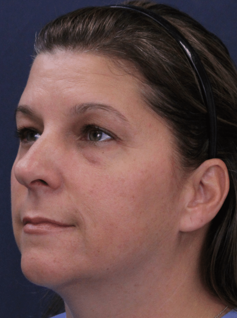 Before Image: Transconjunctival Lower Blepharoplasty with Skin Pinch Excision, Upper Blepharoplasty, Facial Fat Grafting, Lower Lid Resurfacing - left-front-oblique