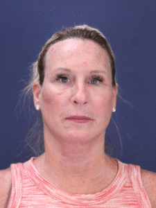 After Image: Deep Plane Face Lift, Deep Plane Neck Lift with Platysmaplasty, Facial Fat Grafting, and an Upper Eyelid Lift