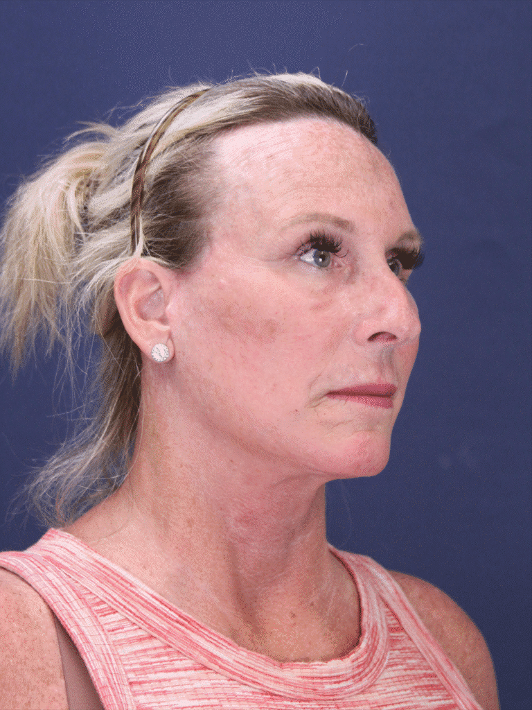 After Image: Deep Plane Face Lift, Deep Plane Neck Lift with Platysmaplasty, Facial Fat Grafting, and an Upper Eyelid Lift - right-front-oblique