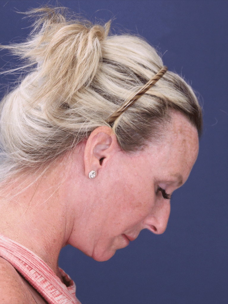 After Image: Deep Plane Face Lift, Deep Plane Neck Lift with Platysmaplasty, Facial Fat Grafting, and an Upper Eyelid Lift - right-side
