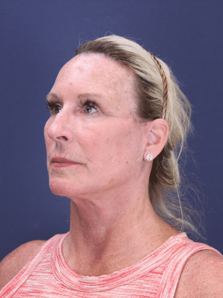 After Image: Deep Plane Face Lift, Deep Plane Neck Lift with Platysmaplasty, Facial Fat Grafting, and an Upper Eyelid Lift - left-front-oblique