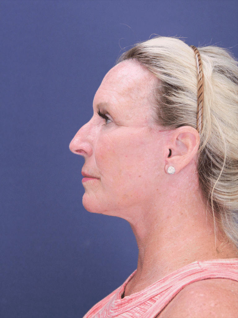 After Image: Deep Plane Face Lift, Deep Plane Neck Lift with Platysmaplasty, Facial Fat Grafting, and an Upper Eyelid Lift - left-side