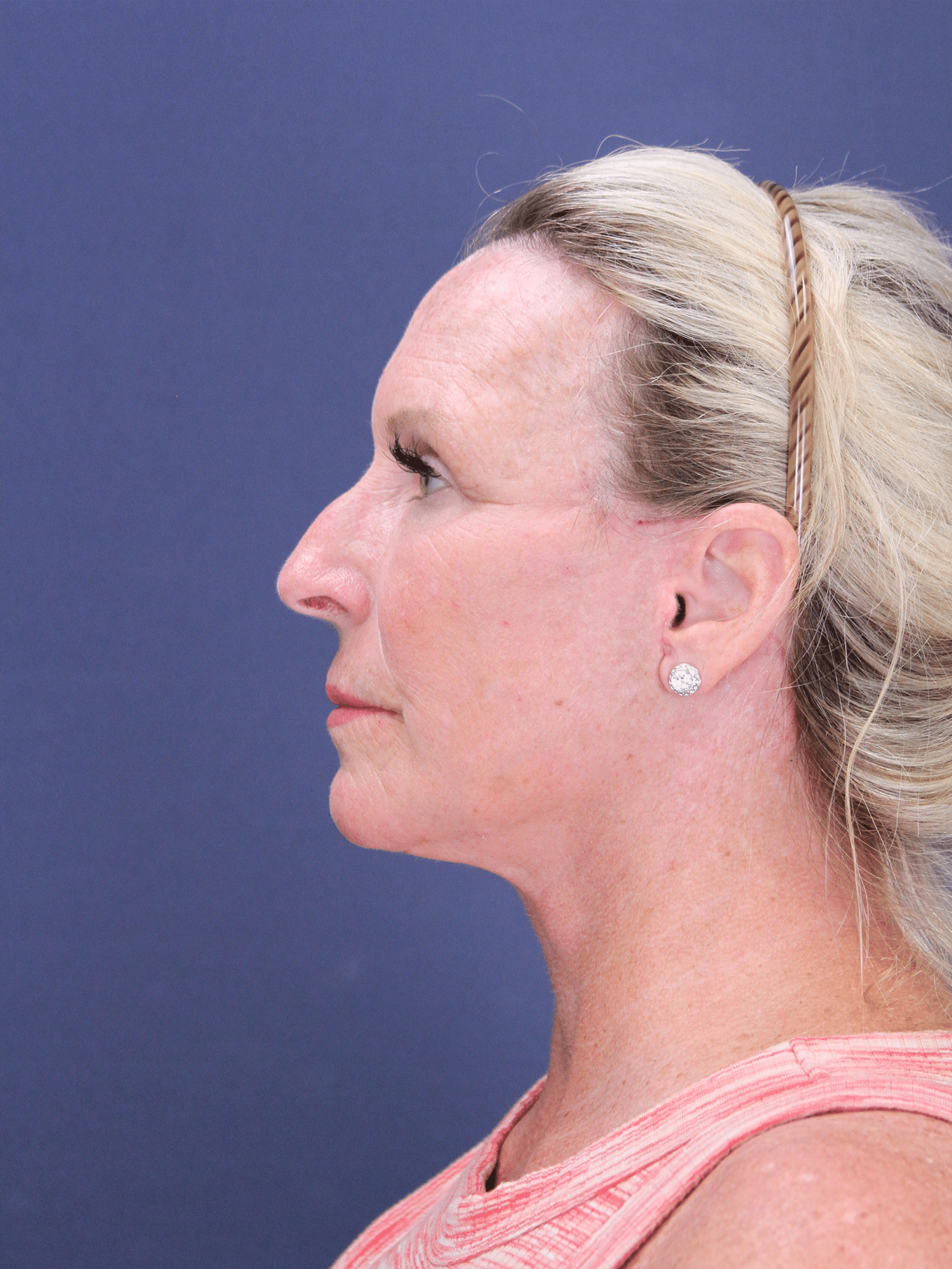 After Image: Deep Plane Face Lift and Neck Lift, Facial Fat Grafting, and Upper Eyelid Lift - left-side