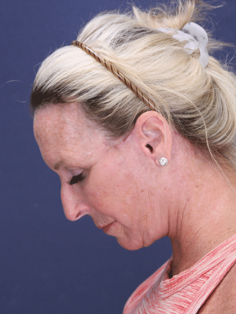 After Image: Deep Plane Face Lift, Deep Plane Neck Lift with Platysmaplasty, Facial Fat Grafting, and an Upper Eyelid Lift - left-side