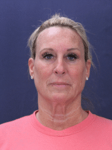 Before Image: Deep Plane Face Lift, Deep Plane Neck Lift with Platysmaplasty, Facial Fat Grafting, and an Upper Eyelid Lift