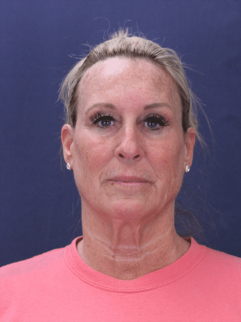 Before Image: Deep Plane Face Lift, Deep Plane Neck Lift with Platysmaplasty, Facial Fat Grafting, and an Upper Eyelid Lift - front