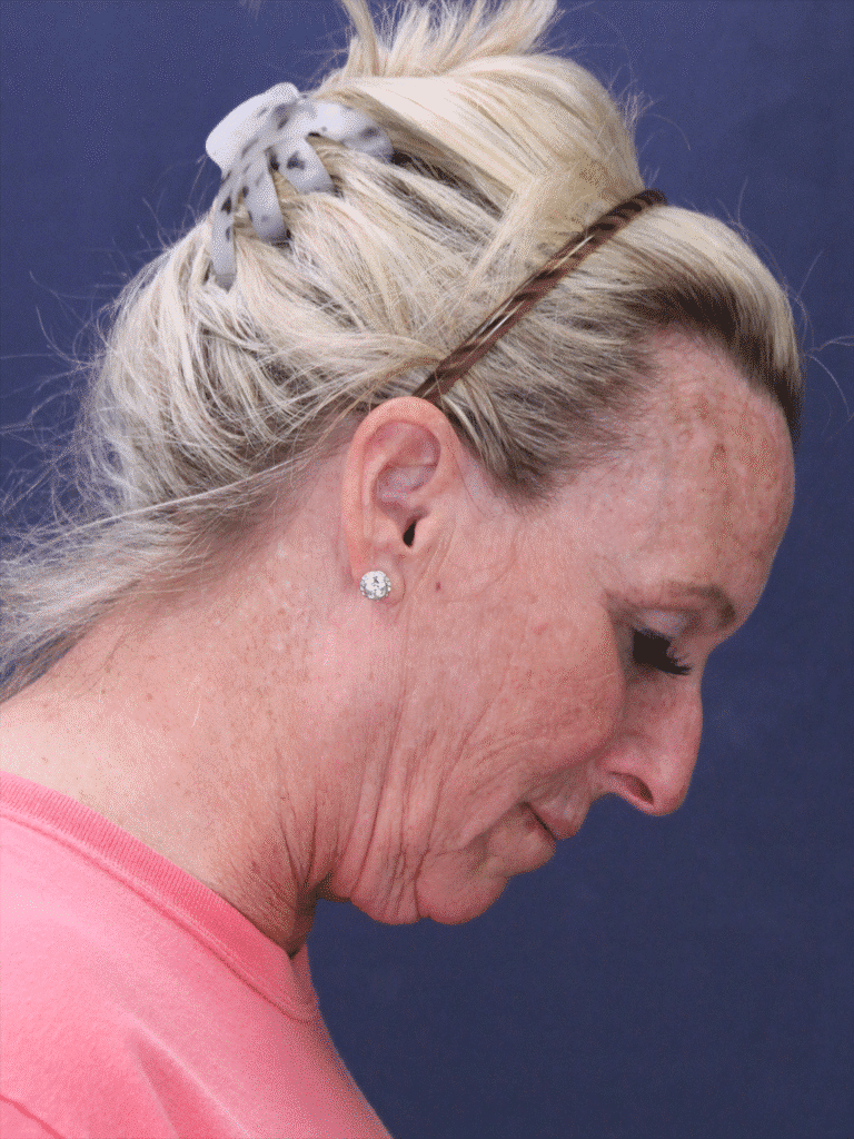 Before Image: Deep Plane Face Lift, Deep Plane Neck Lift with Platysmaplasty, Facial Fat Grafting, and an Upper Eyelid Lift - right-side