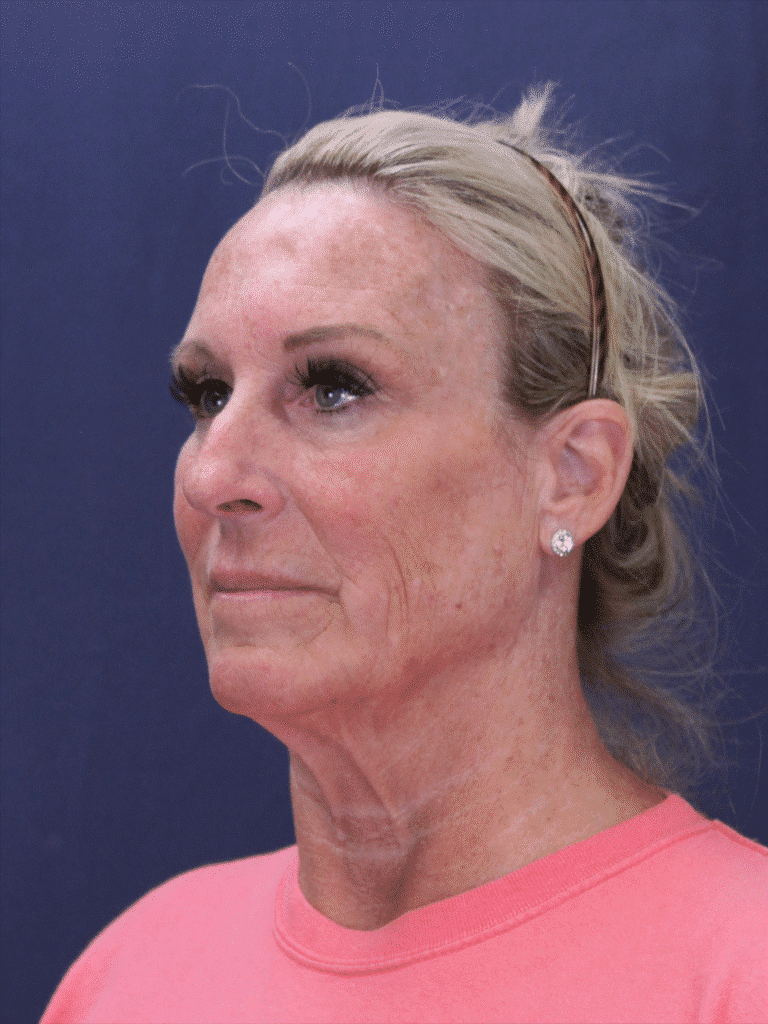 Before Image: Deep Plane Face Lift, Deep Plane Neck Lift with Platysmaplasty, Facial Fat Grafting, and an Upper Eyelid Lift - left-front-oblique