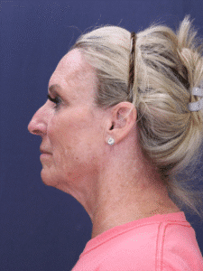 Before Image: Deep Plane Face Lift and Neck Lift, Facial Fat Grafting, and Upper Eyelid Lift