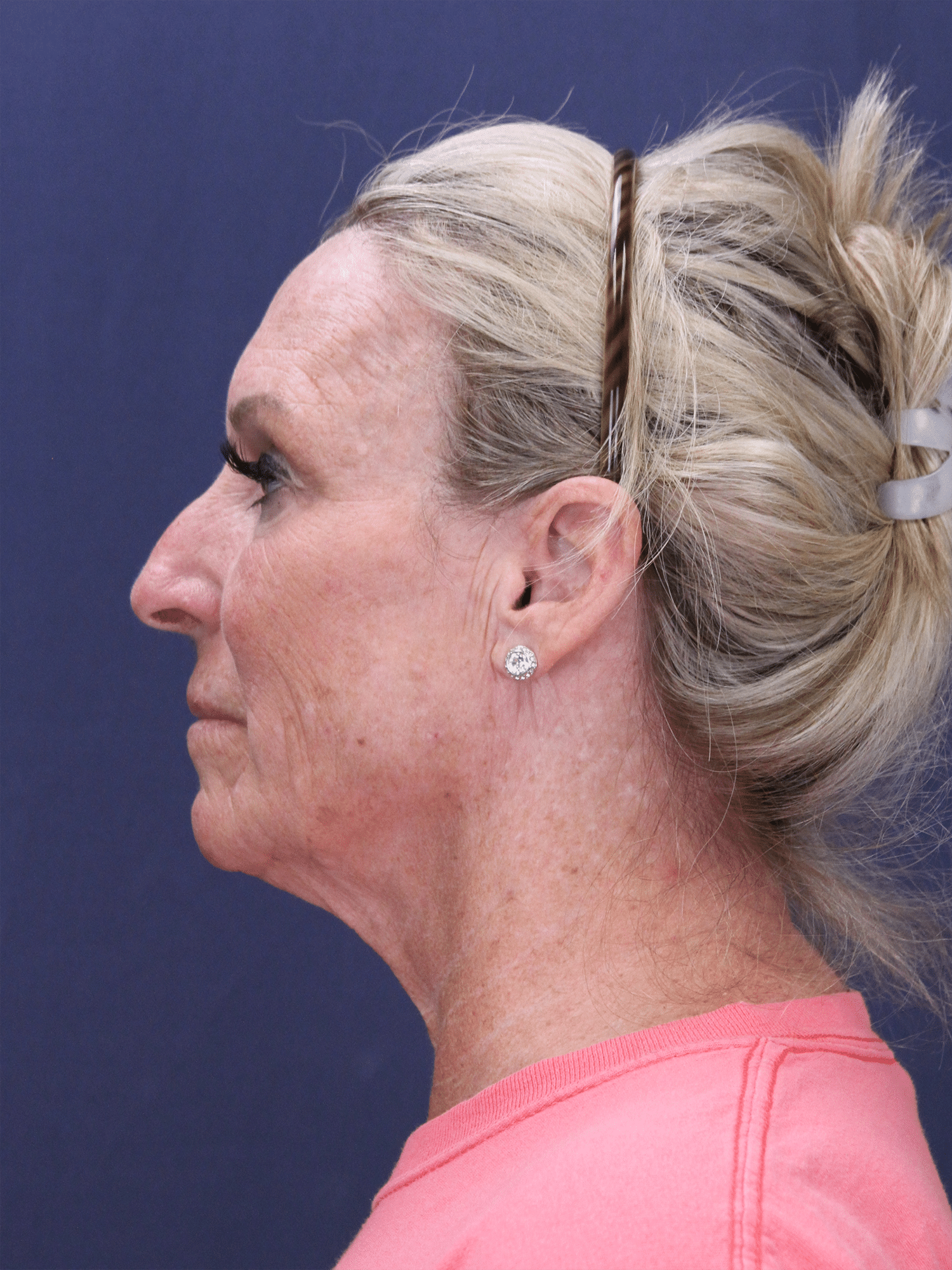 Before Image: Deep Plane Face Lift and Neck Lift, Facial Fat Grafting, and Upper Eyelid Lift - left-side