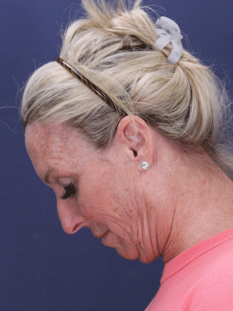 Before Image: Deep Plane Face Lift, Deep Plane Neck Lift with Platysmaplasty, Facial Fat Grafting, and an Upper Eyelid Lift - left-side