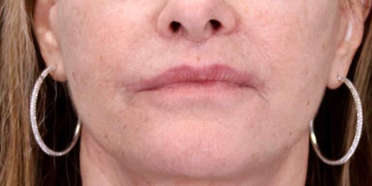 After Image: Bullhorn Lip Lift, Corner Lip Lift - front