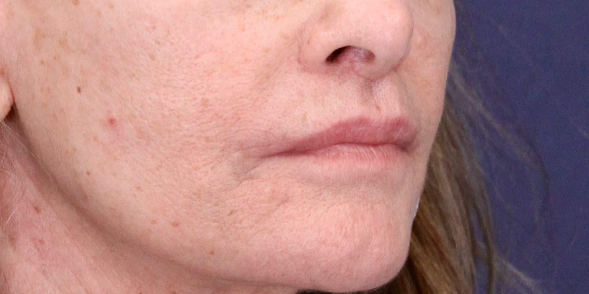 After Image: Lip Lift - right-front-oblique