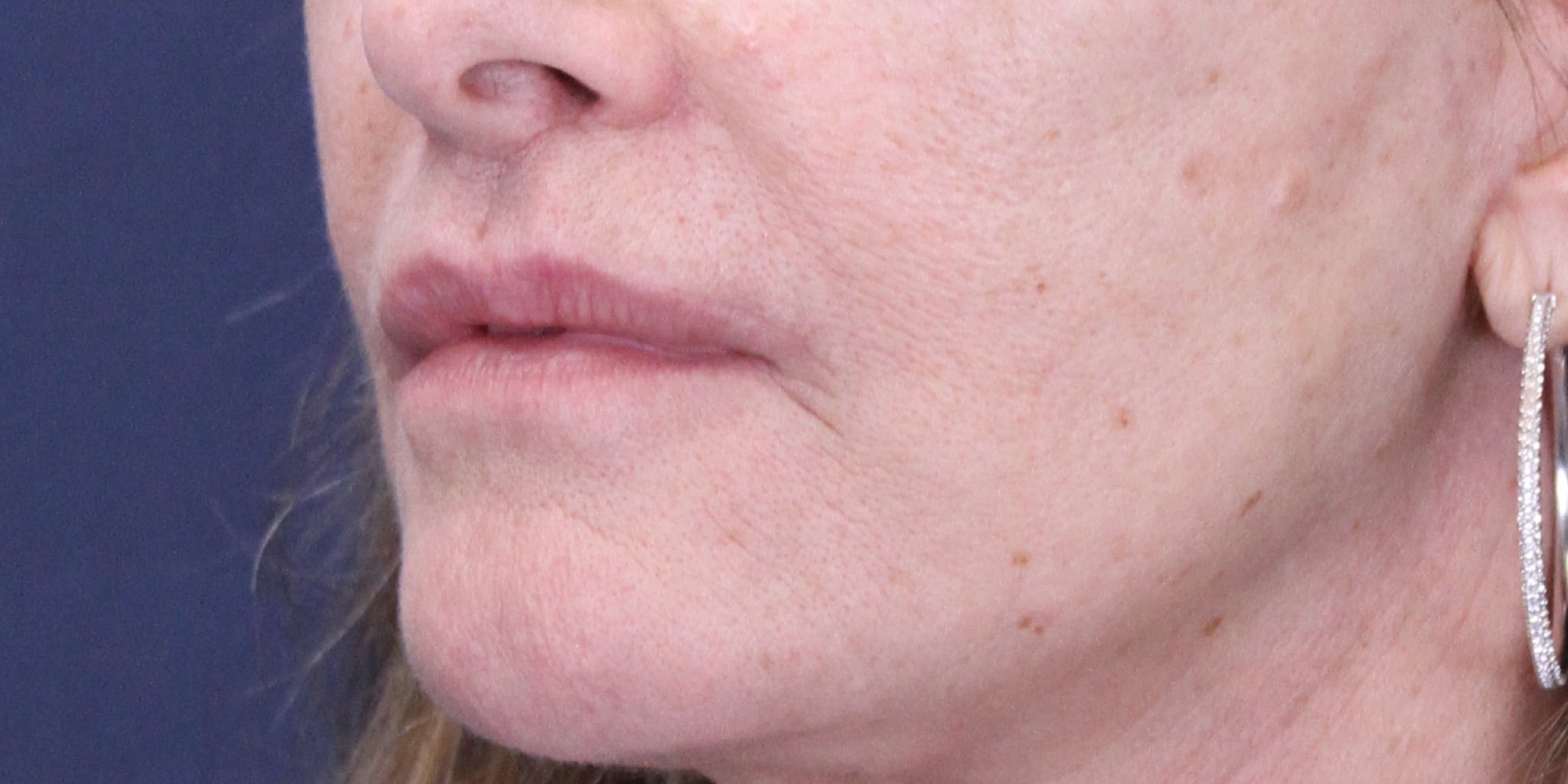 After Image: Lip Lift - left-front-oblique