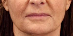 Before Image: Bullhorn Lip Lift, Corner Lip Lift
