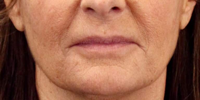 Before Image: Bullhorn Lip Lift, Corner Lip Lift - front