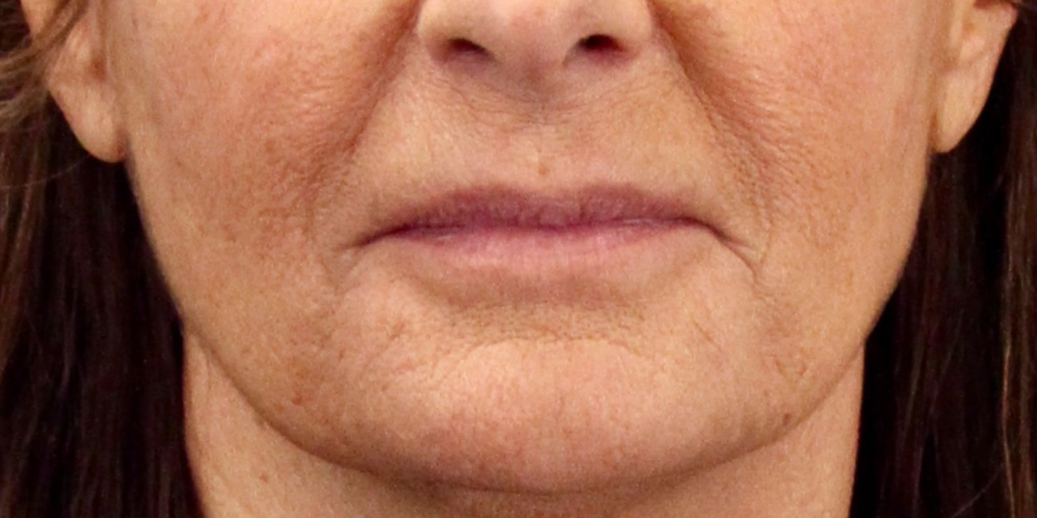 Before Image: Lip Lift - front