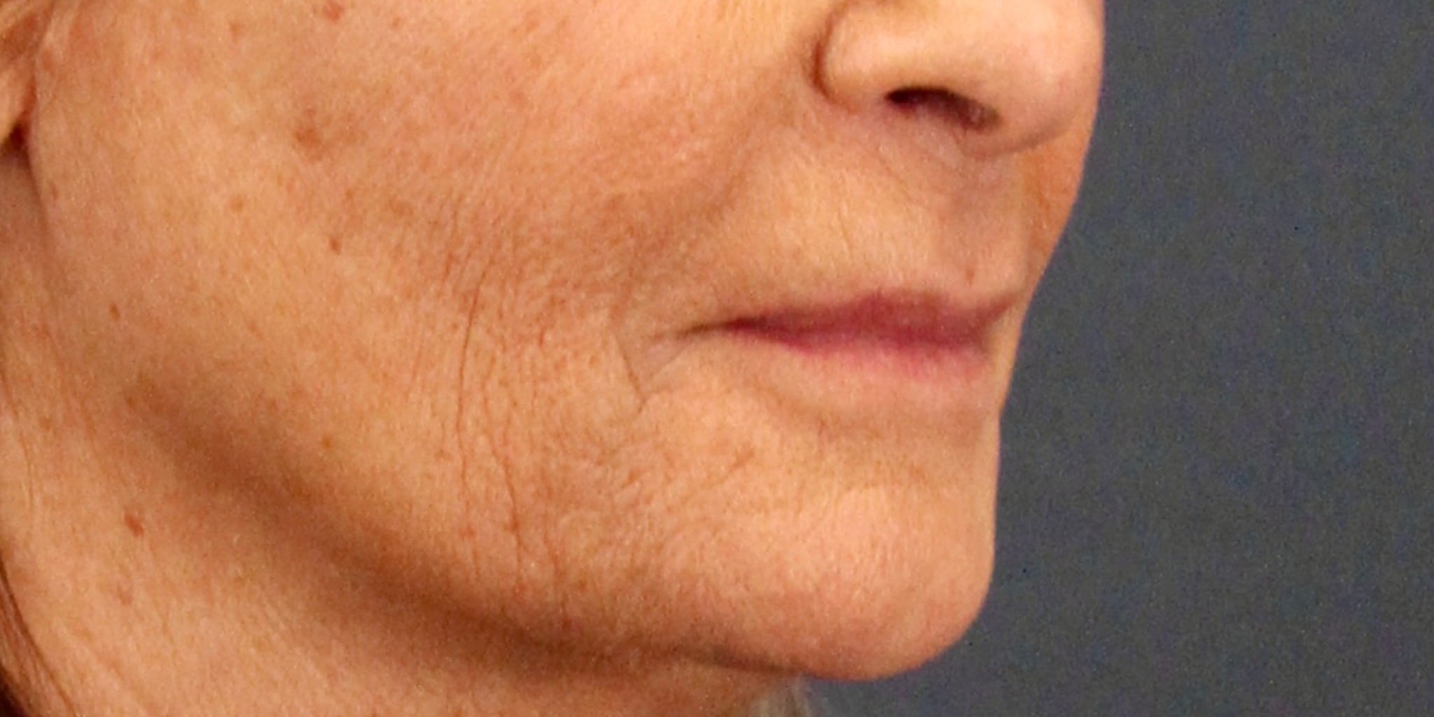 Before Image: Lip Lift - right-front-oblique